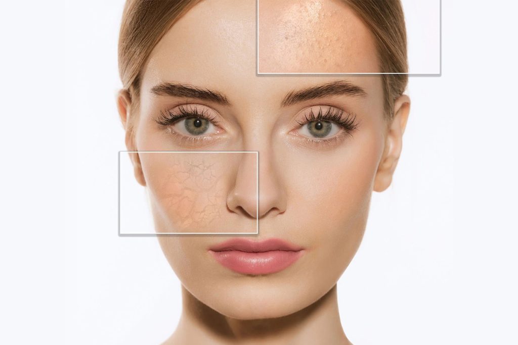 در پوست مختلط نواحی T شکل صورت چرب بوده و سایر نقاط خشک هستند